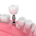 Qual a duração do implante dentário?