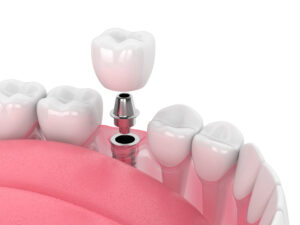 Leia mais sobre o artigo Qual a duração do implante dentário?