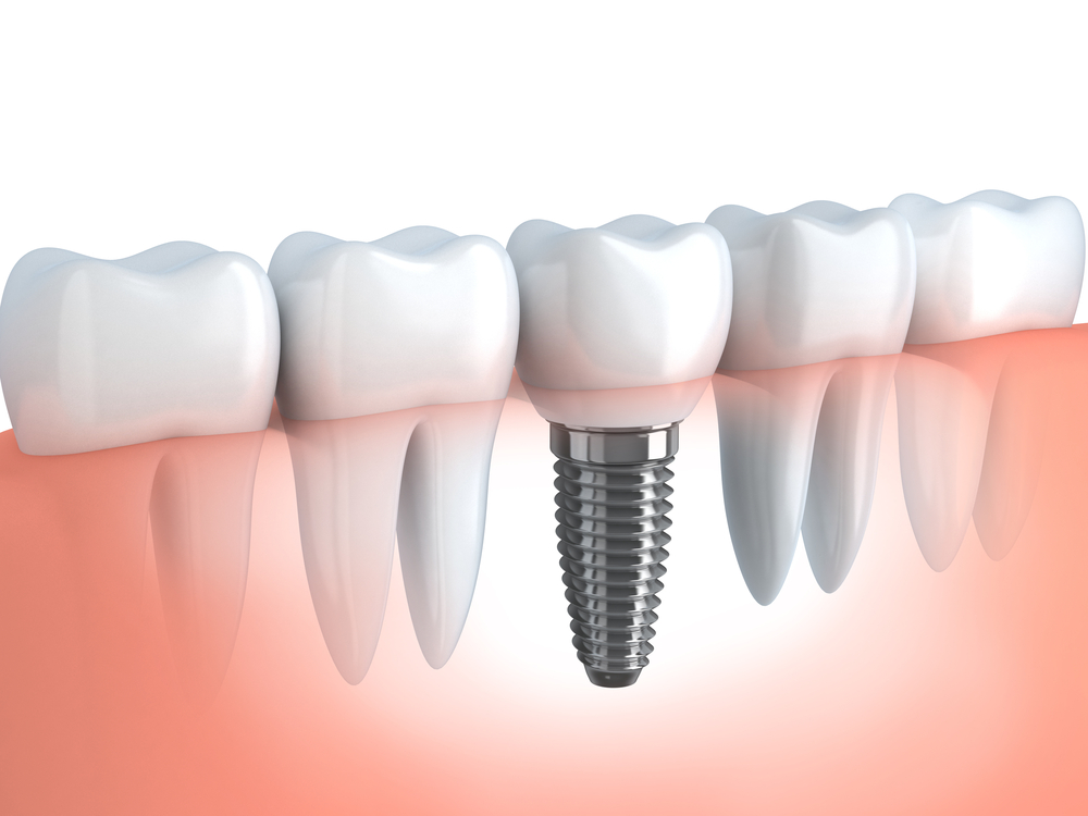 duração do implante dentário